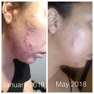 Super Acne Fighter / Organic Acne Treatment / Acne / Essential Oils / Natural  Acne Treatment / Acne Scars / Hormonal Acne / Cystic Acne